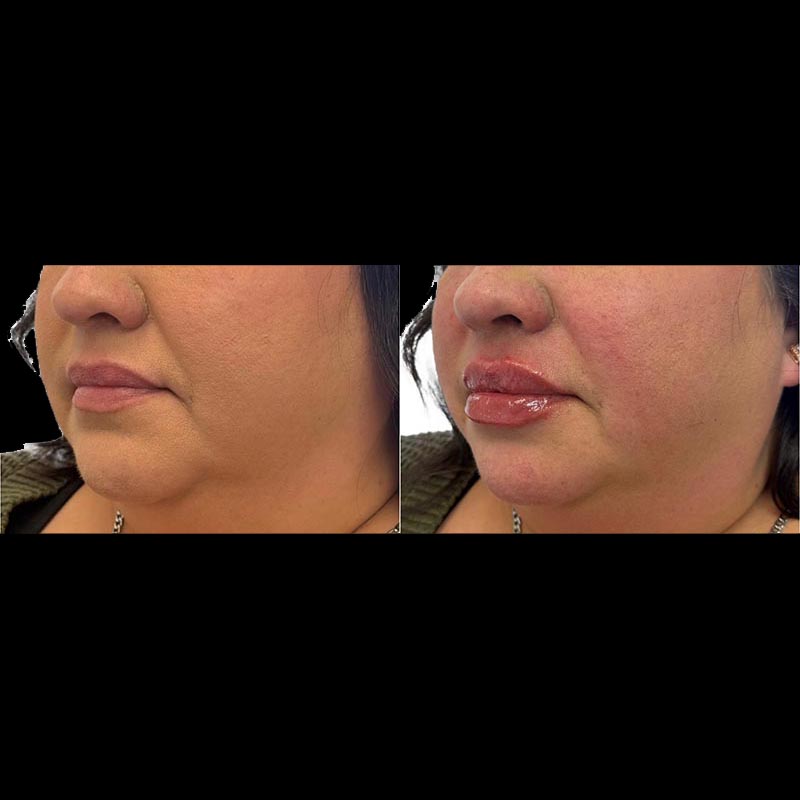 Lip Enhancement Before & After Image