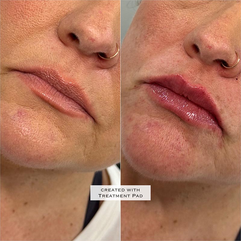 Lip Enhancement Before & After Image