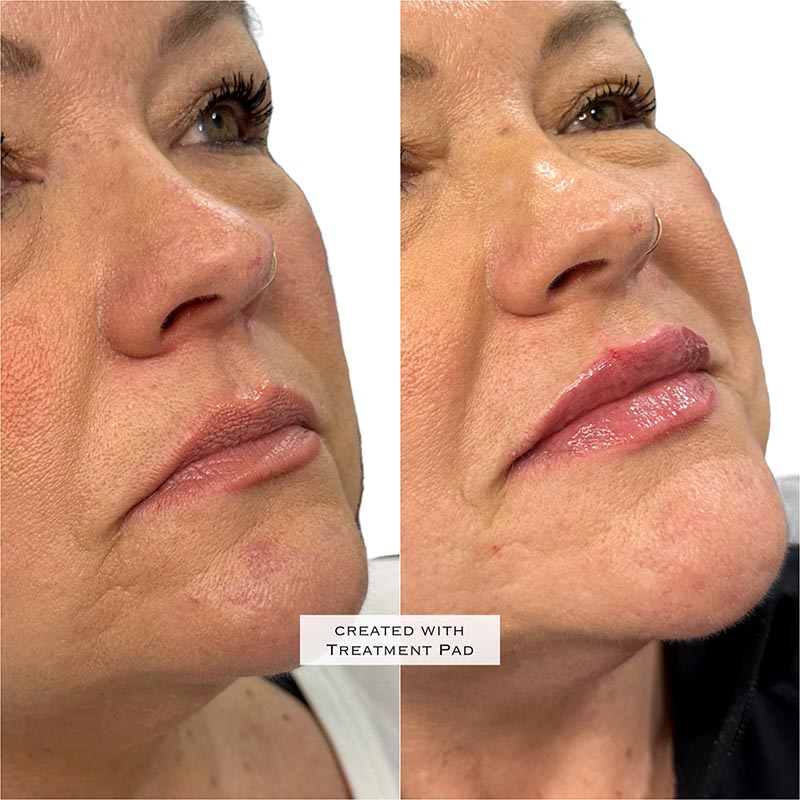 Lip Enhancement Before & After Image