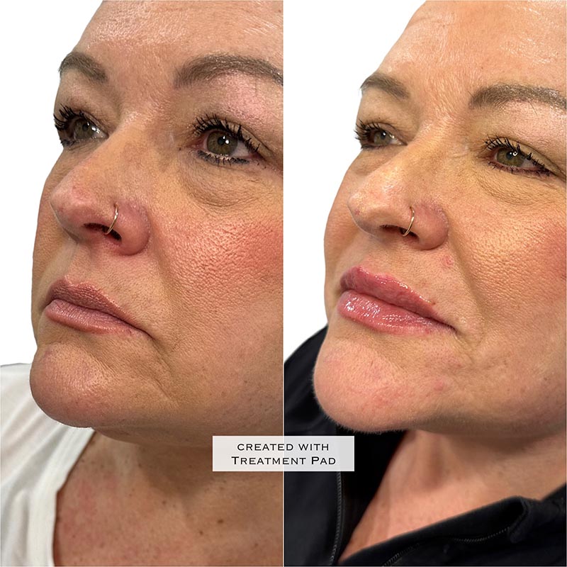 Lip Enhancement Before & After Image