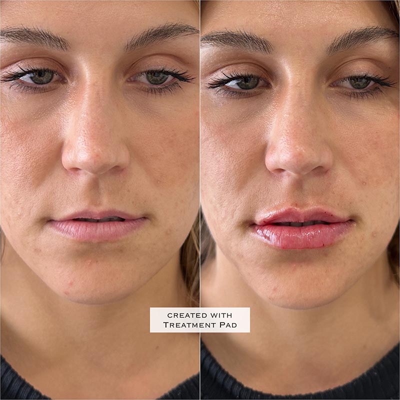 Lip Enhancement Before & After Image