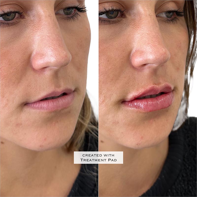 Lip Enhancement Before & After Image