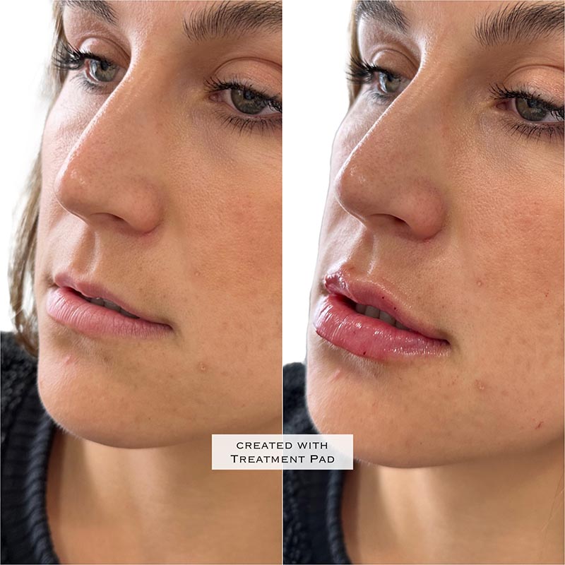 Lip Enhancement Before & After Image