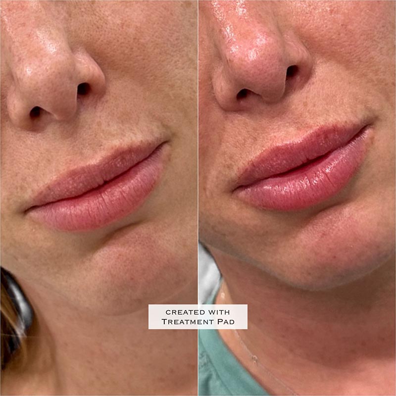 Lip Enhancement Before & After Image