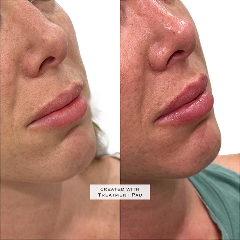 Lip Enhancement Before & After Image