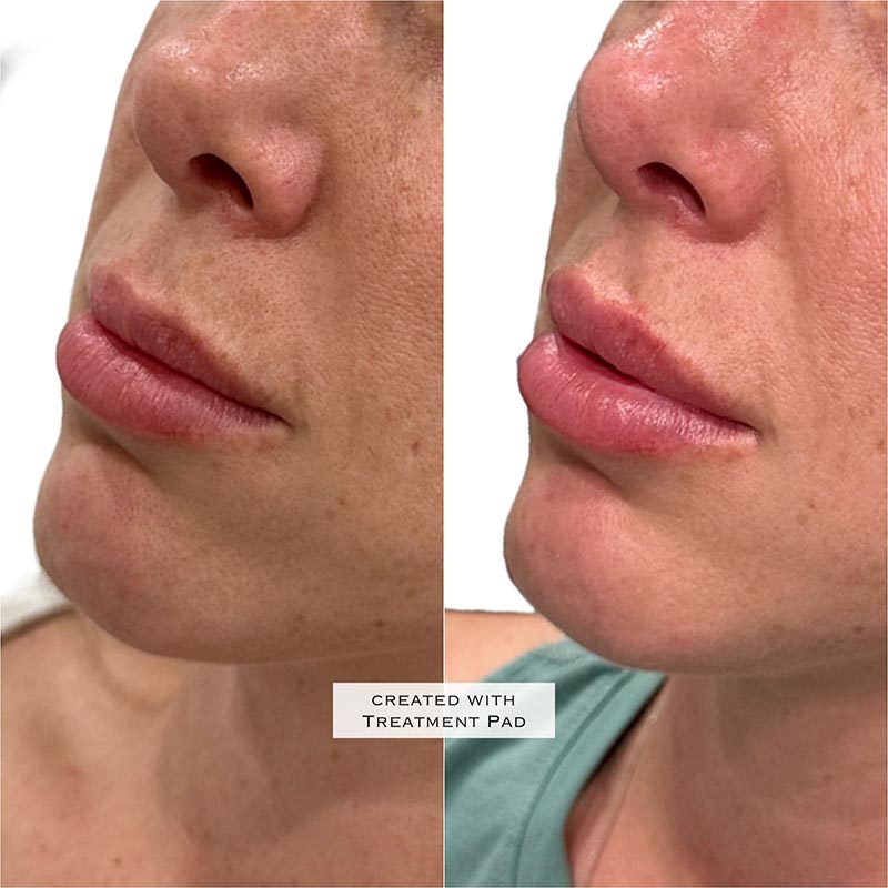 Lip Enhancement Before & After Image