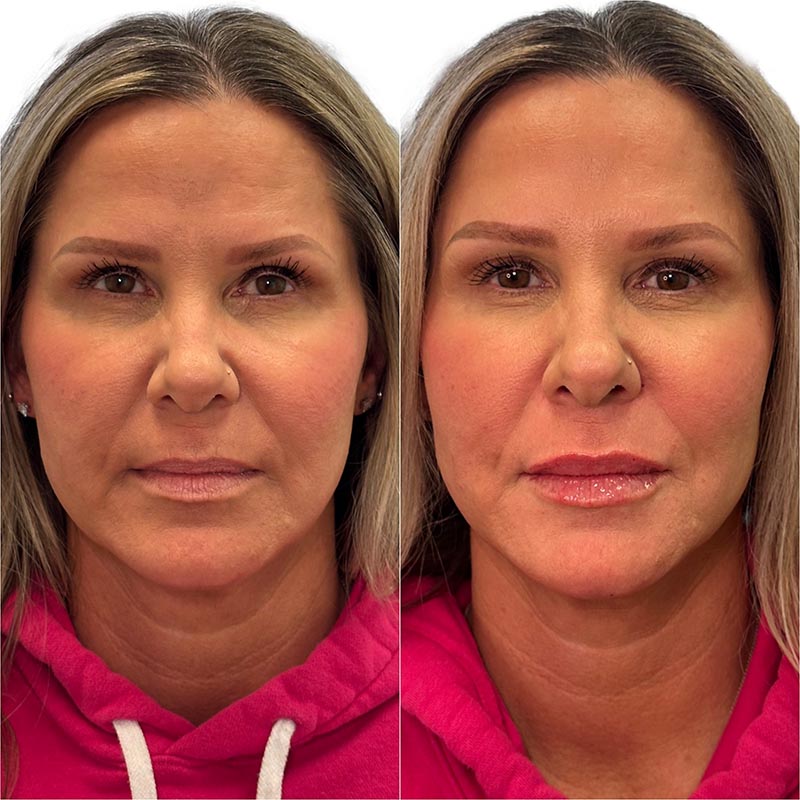Lip Enhancement Before & After Image
