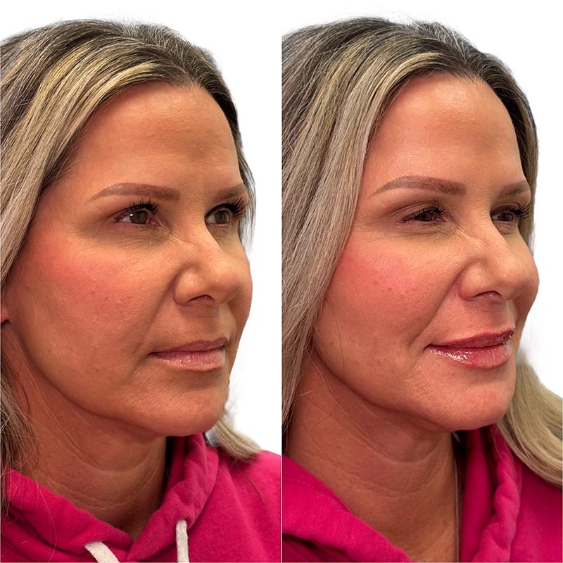 Lip Enhancement Before & After Image
