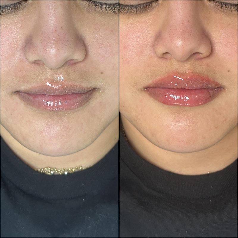 Lip Enhancement Before & After Image