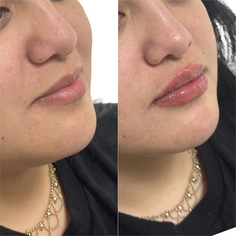 Lip Enhancement Before & After Image