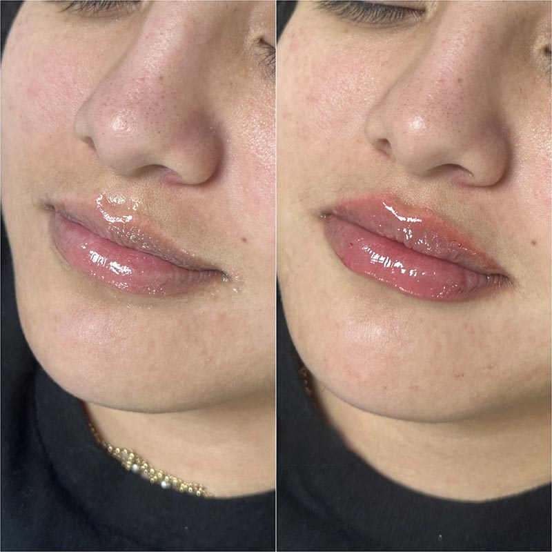 Lip Enhancement Before & After Image