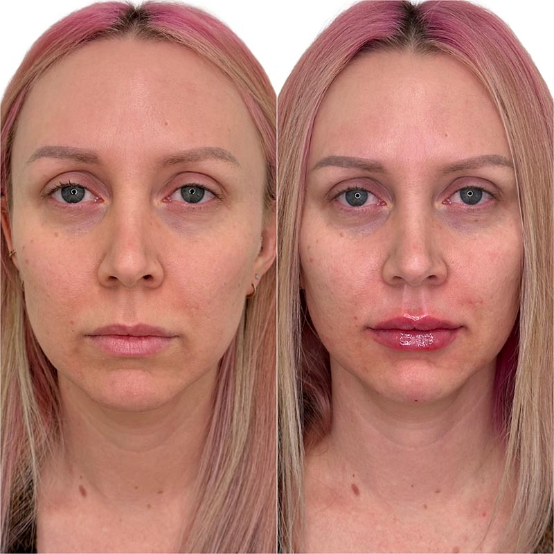 Lip Enhancement Before & After Image