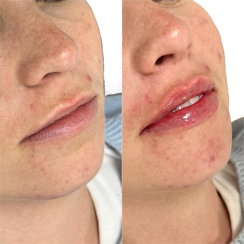 Lip Enhancement Before & After Image