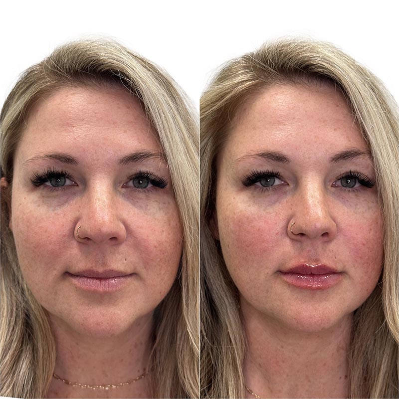 Lip Enhancement Before & After Image