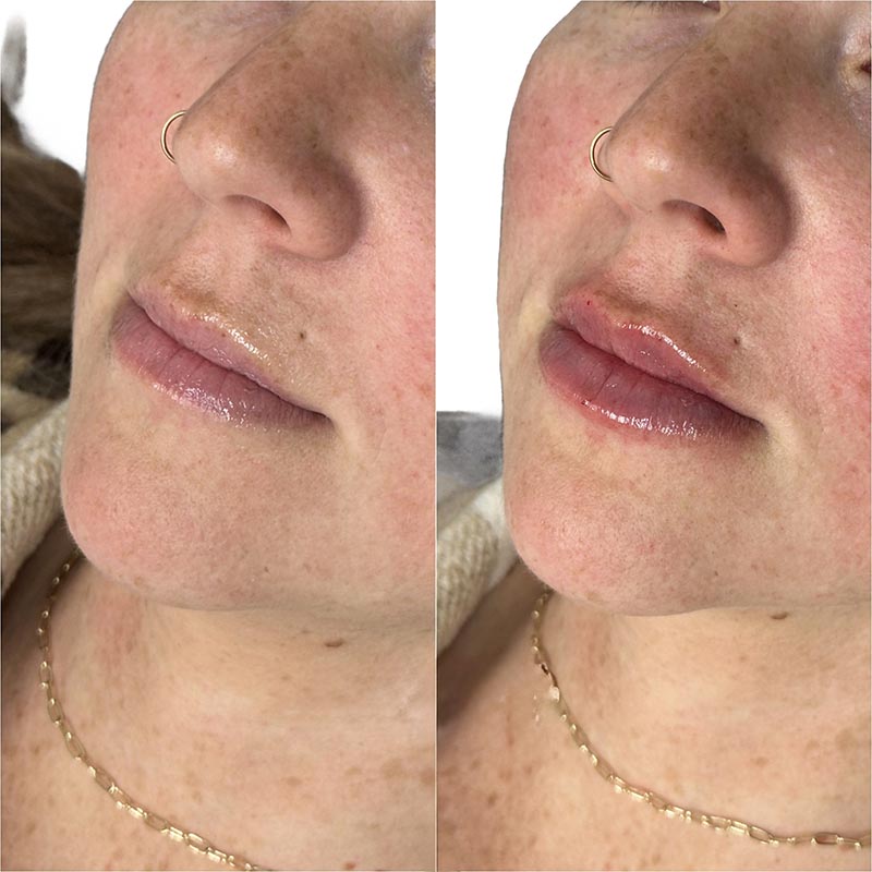 Lip Enhancement Before & After Image