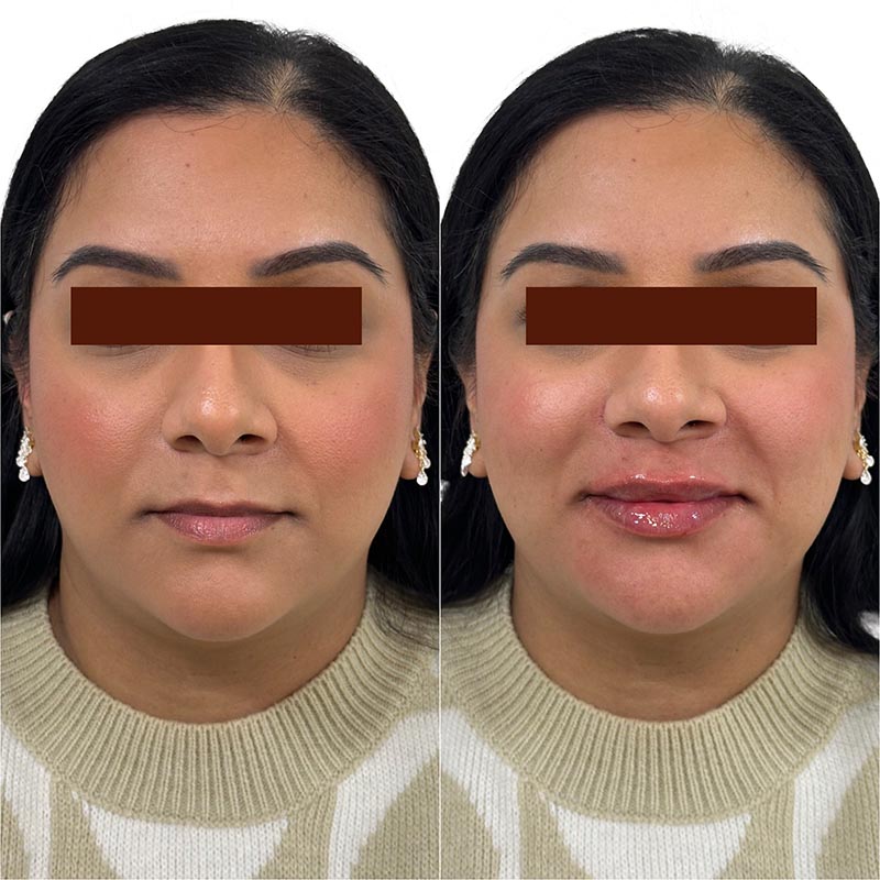 Lip Enhancement Before & After Image