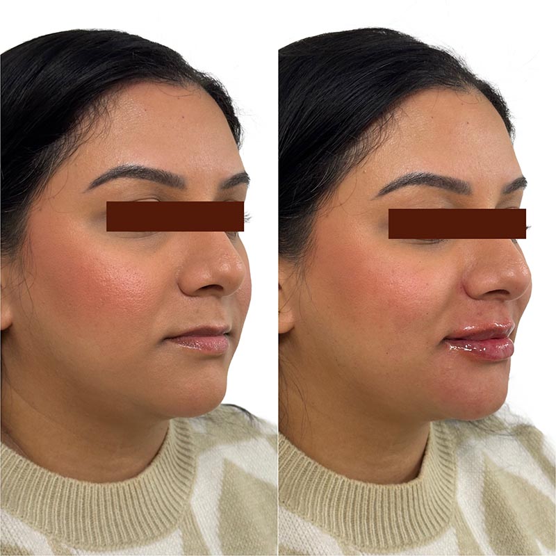 Lip Enhancement Before & After Image