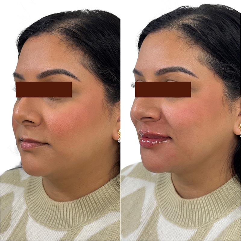 Lip Enhancement Before & After Image