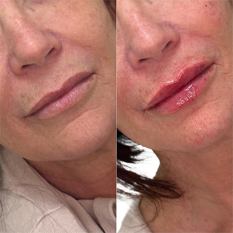Lip Enhancement Before & After Image