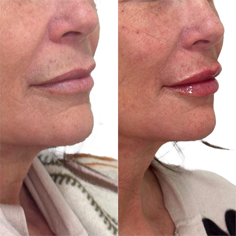 Lip Enhancement Before & After Image