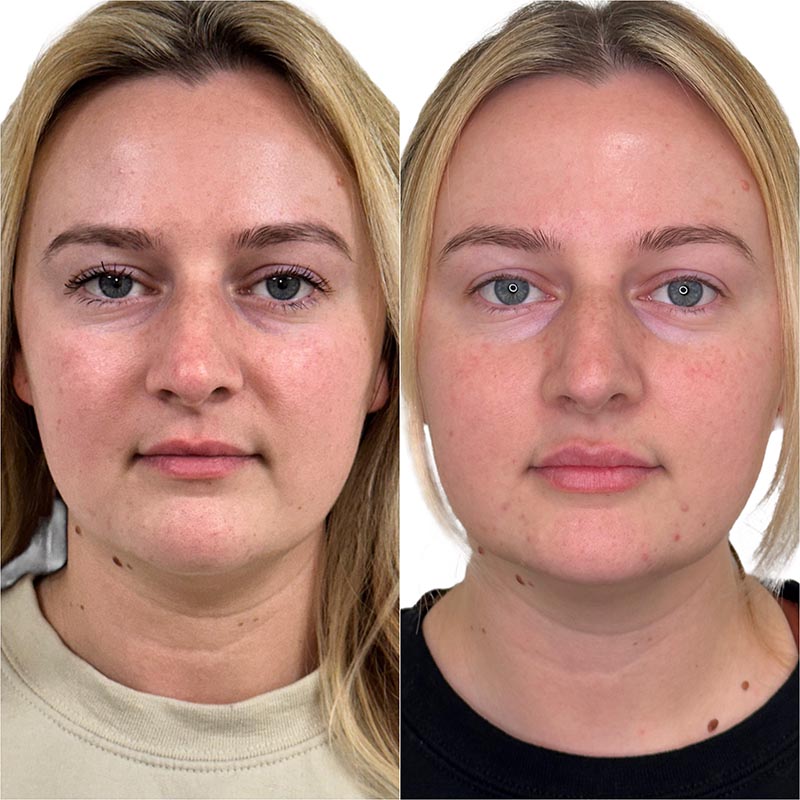 Lip Enhancement Before & After Image