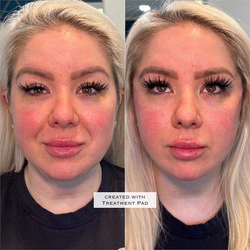 PDO Threads Before & After Image
