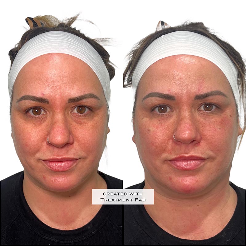 PRF Before & After Image