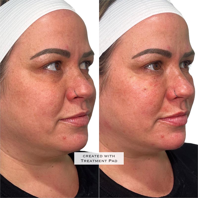 PRF Before & After Image