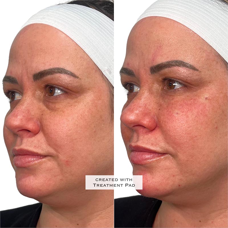 PRF Before & After Image