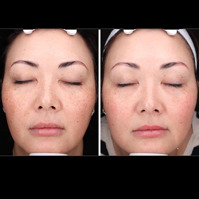 Aerolase Before & After Image