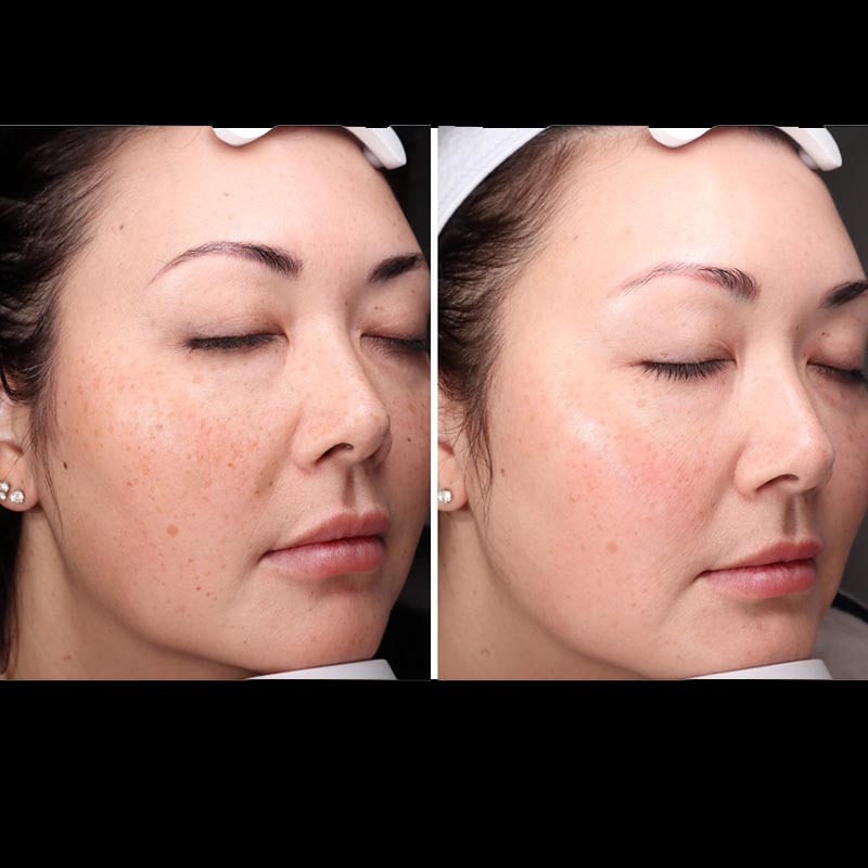 Aerolase Before & After Image