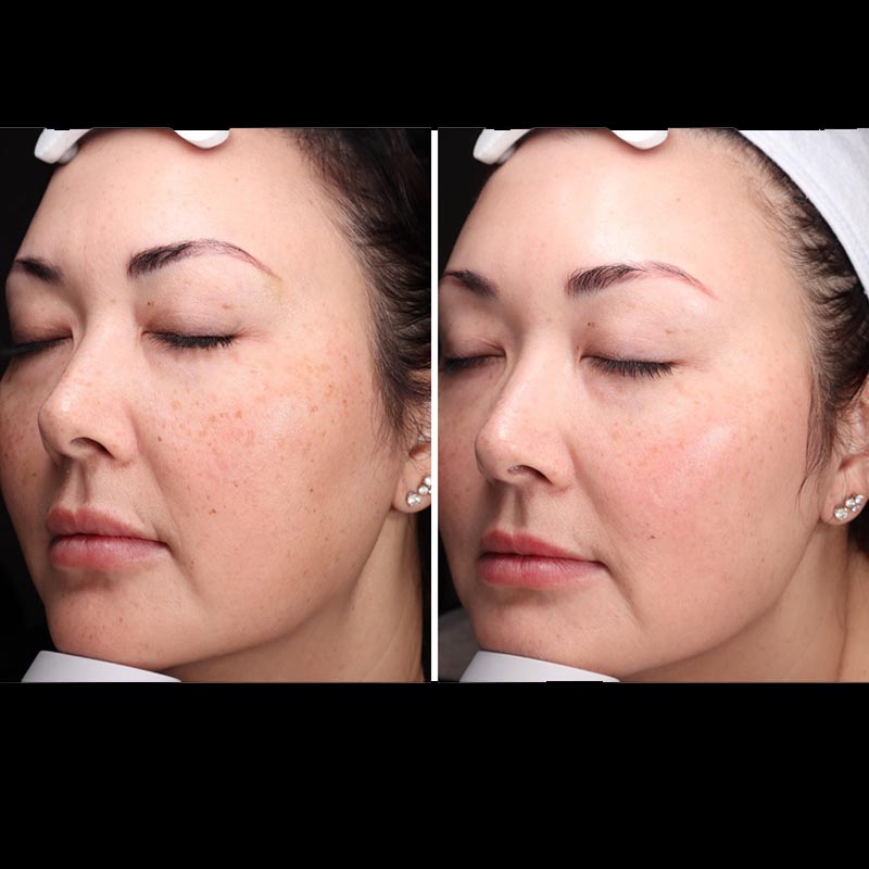 Aerolase Before & After Image