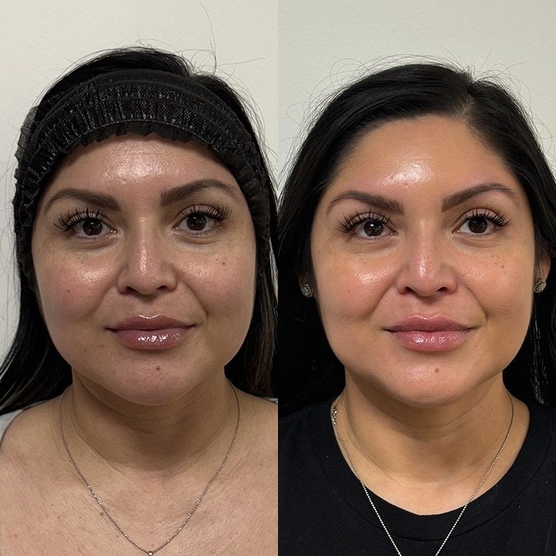 Ultherapy Before & After Image