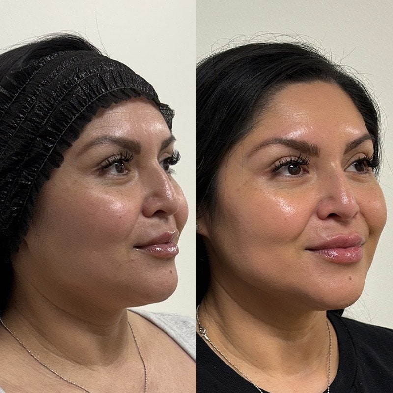 Ultherapy Before & After Image