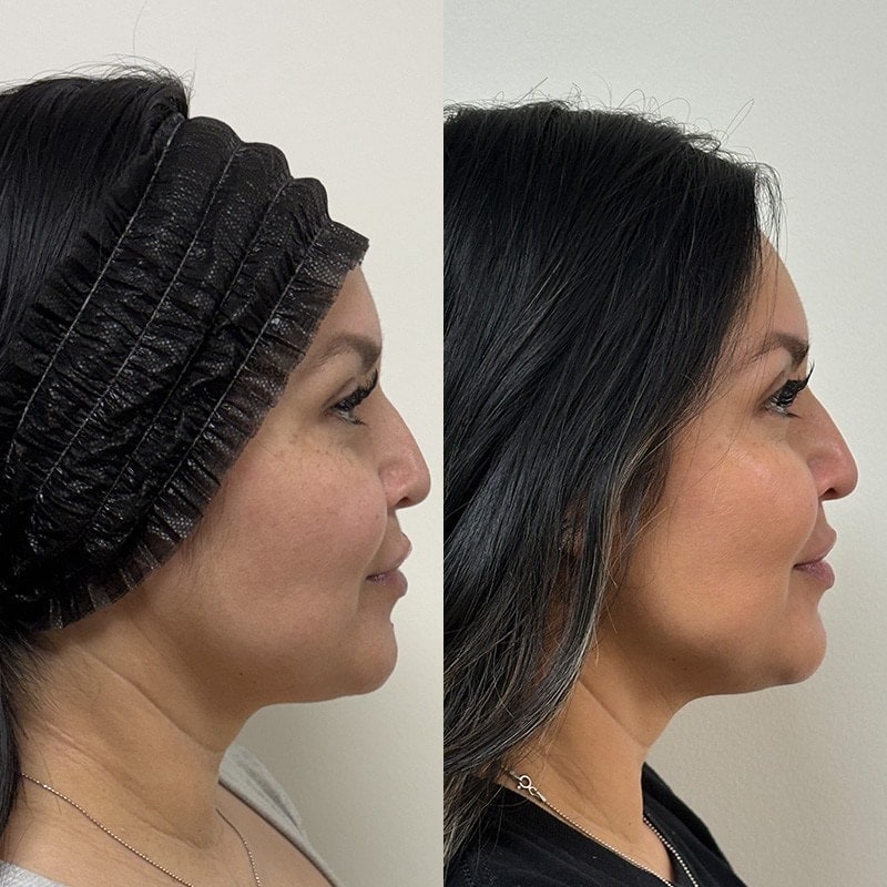 Ultherapy Before & After Image