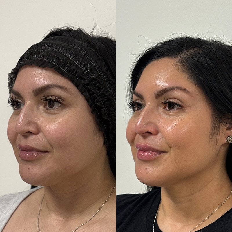 Ultherapy Before & After Image
