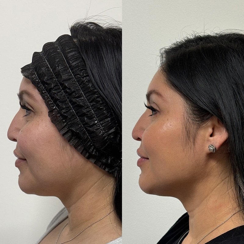 Ultherapy Before & After Image