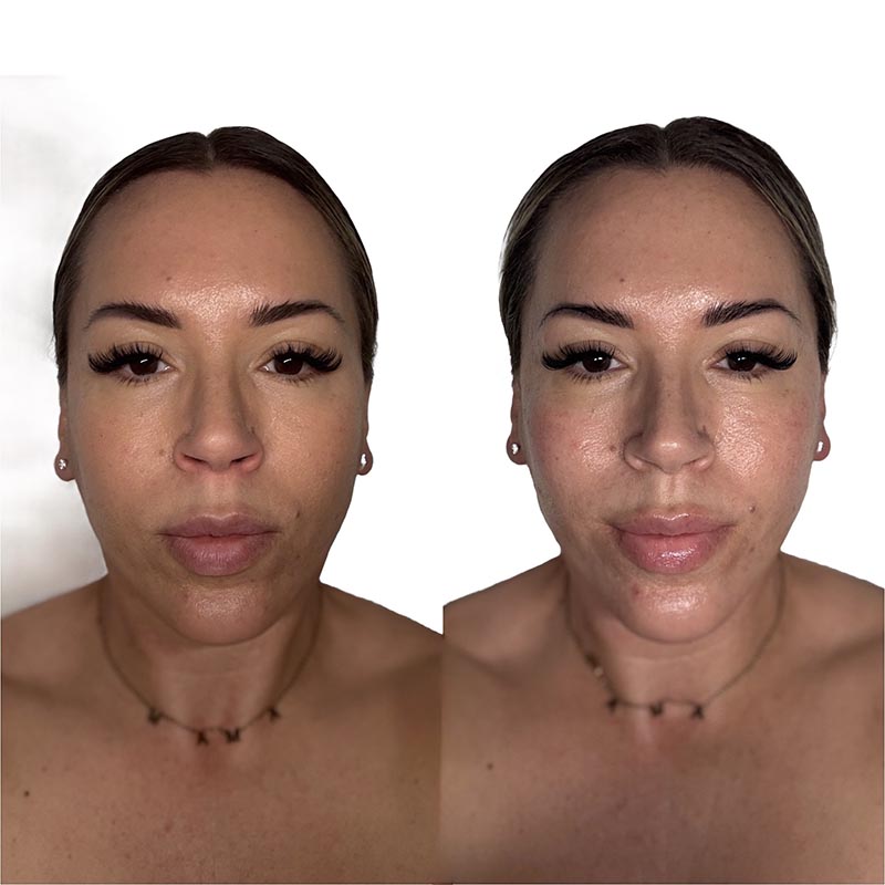 Facial Before & After Image