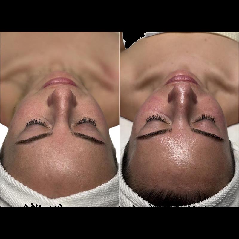 Facial Before & After Image