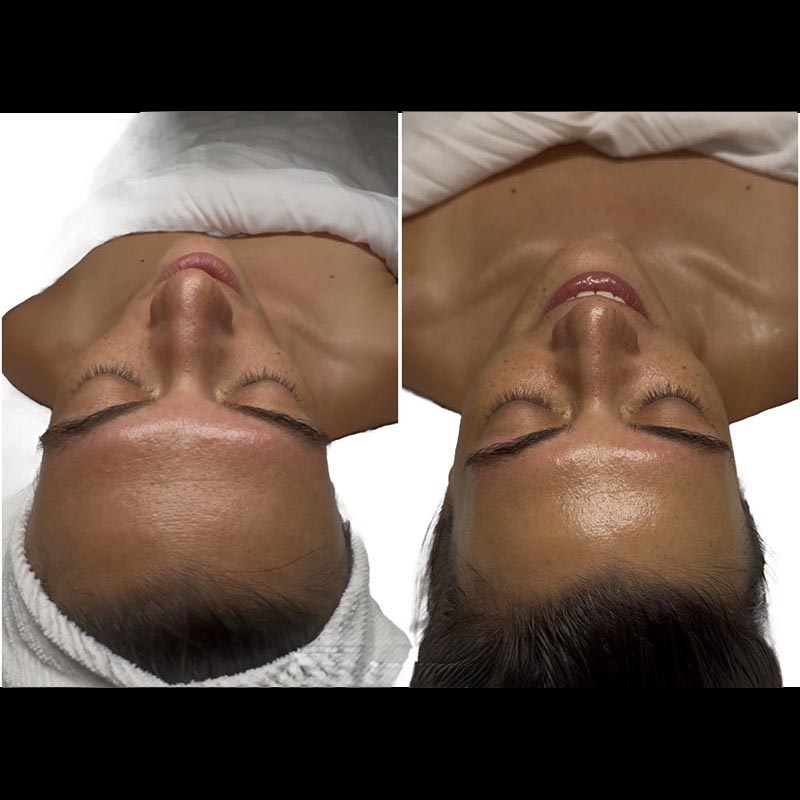 Facial Before & After Image