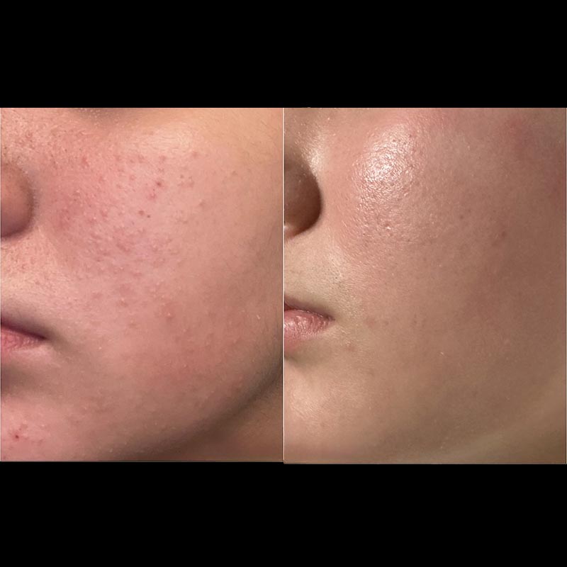 Facial Before & After Image