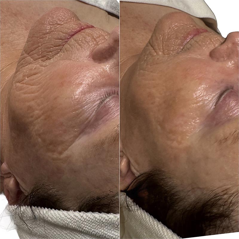 Facial Before & After Image