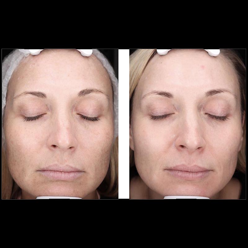 Skincare Before & After Image