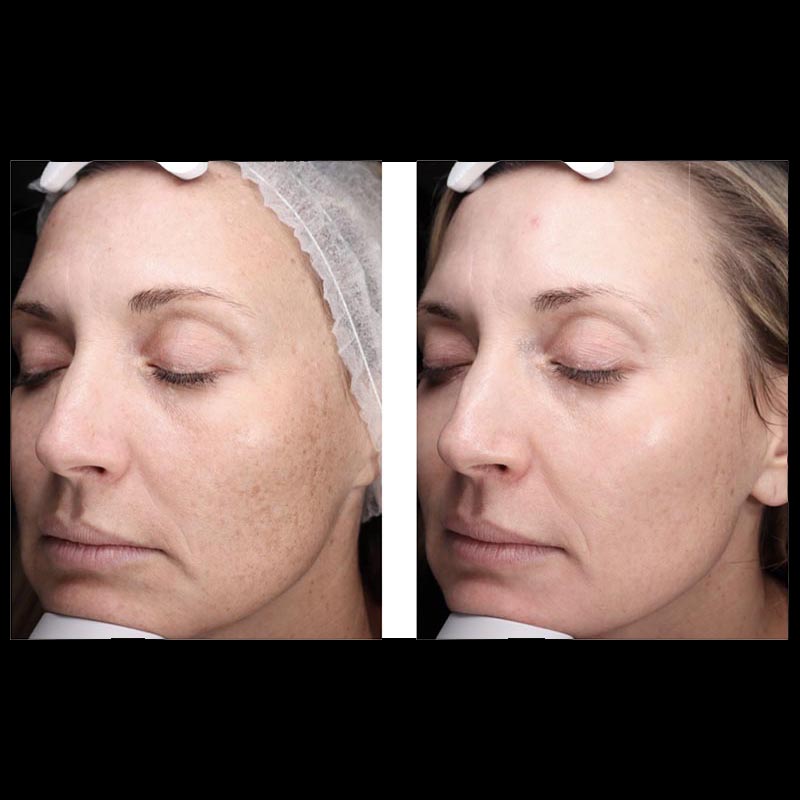 Skincare Before & After Image