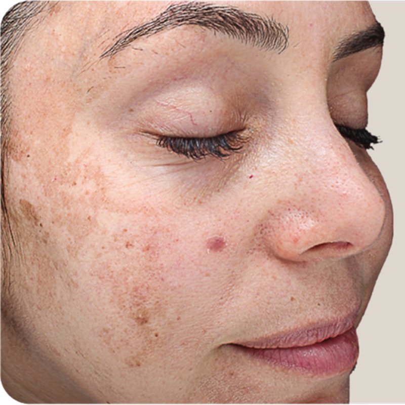 Vi Peels Before & After Image