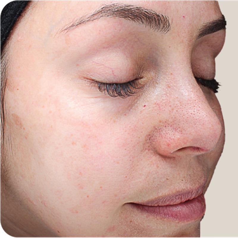Vi Peels Before & After Image