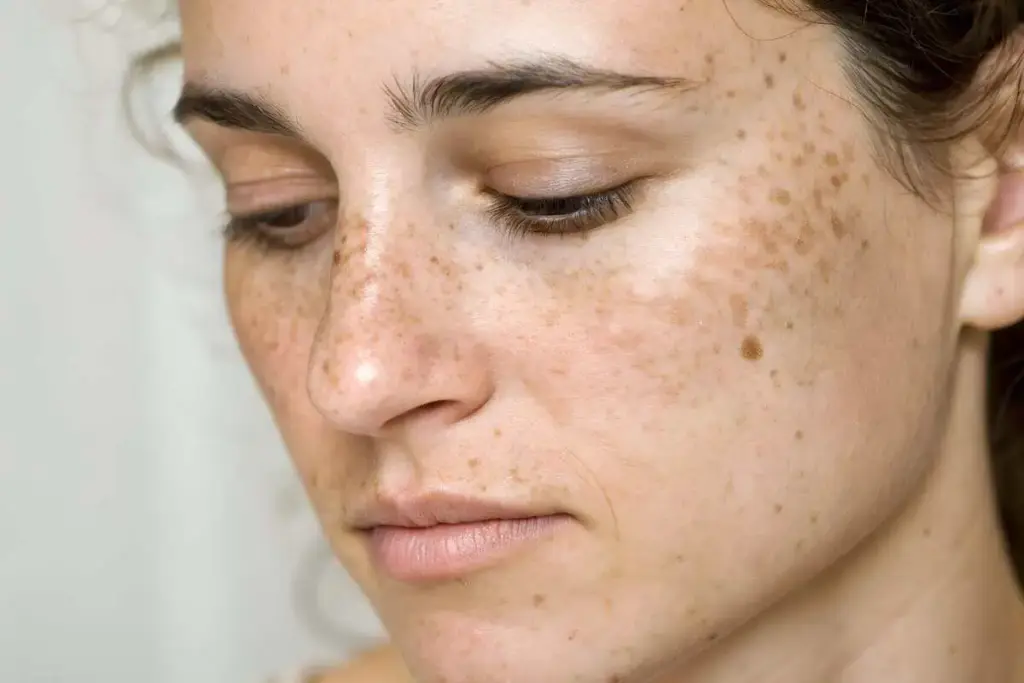 Woman with facial hyperpigmentation and uneven skin tone at Pretty Please Aesthetics in Sacramento and Roseville, CA
